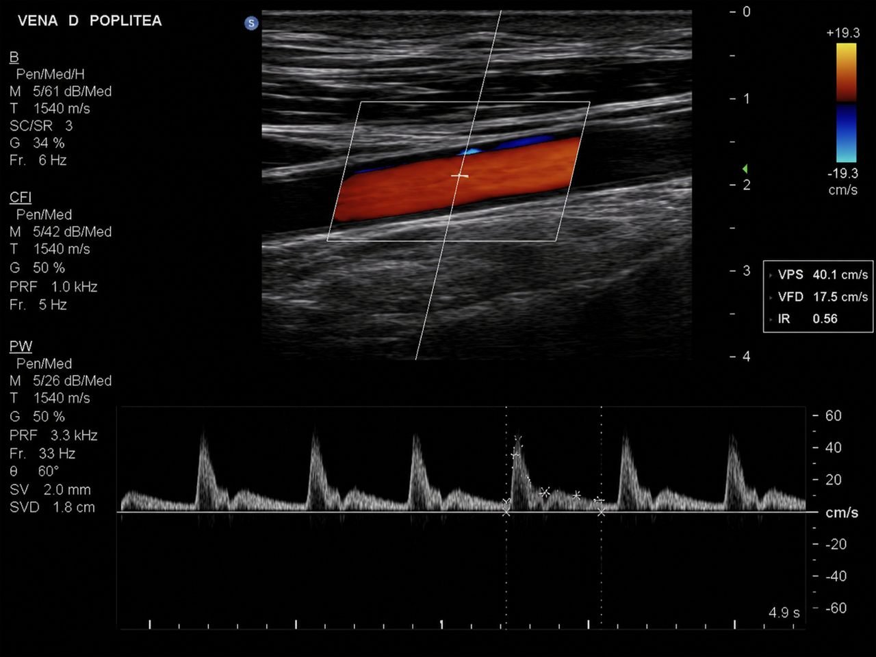 Estudio de ultrasonido Doppler vascular periférico